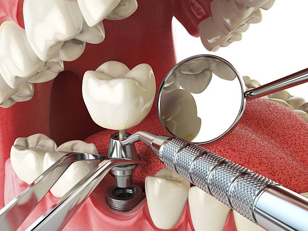 Best Emergency Tooth Extraction in Chattanoo Valley, GA